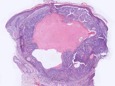 Histologie sebaceoma