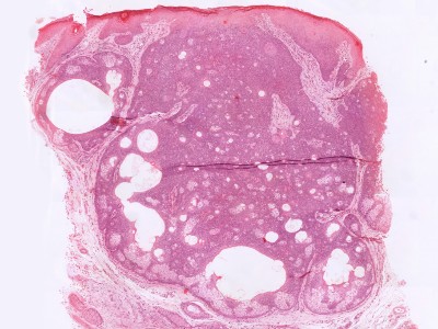Histologie sebaceous adenoma