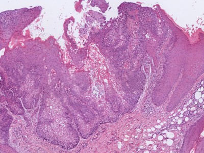 Histologie sebaceous adenoma