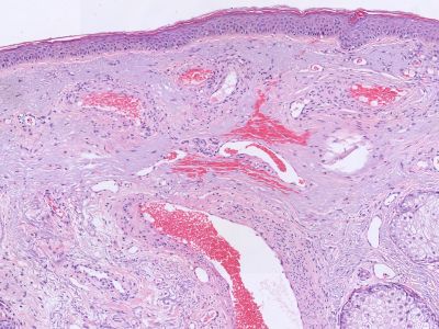 Histologie spider naevus