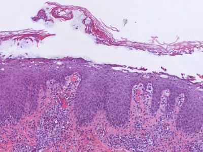 Histologie staphylococcal scalded skin syndrome