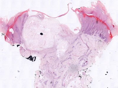Histologie superficieel acraal fibromyxoma