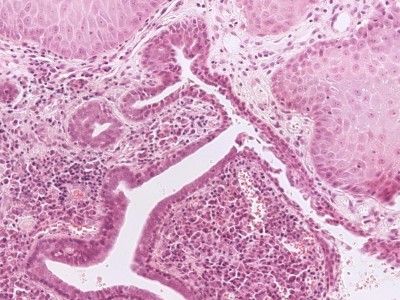 Histologie syringocystadenoma papilliferum