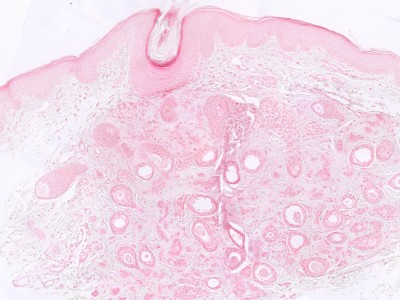 Histologie syringoma