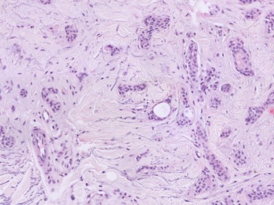 Histologie syringoma