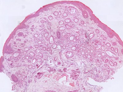Histologie syringoma