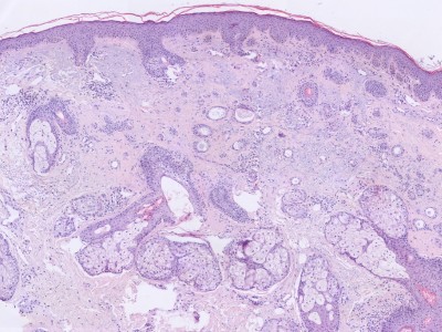 Histologie syringoma