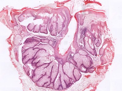 Histologie talgklierhyperplasie