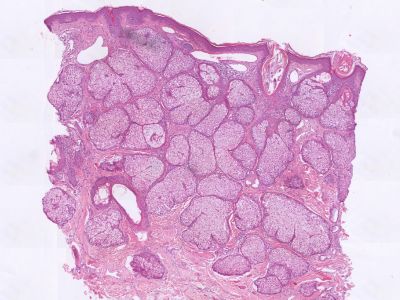 Histologie talgklierhyperplasie