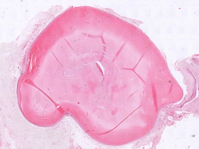 Histologie trichilemmale cyste