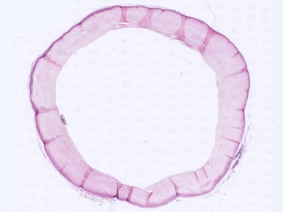Histologie trichilemmale cyste