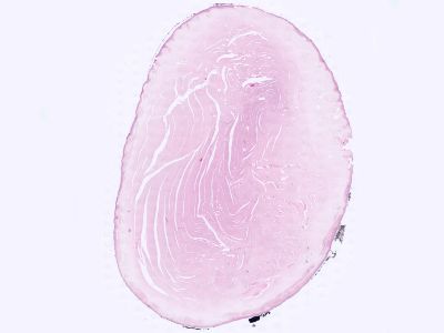 Histologie trichilemmale cyste