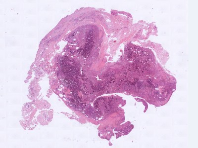 Histologie tumorale calcinosis van de hand