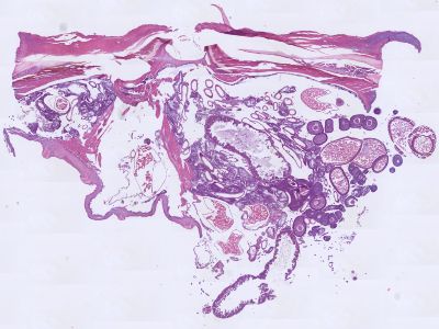 Histologie tungiasis