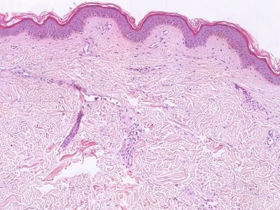 Histologie urticaria