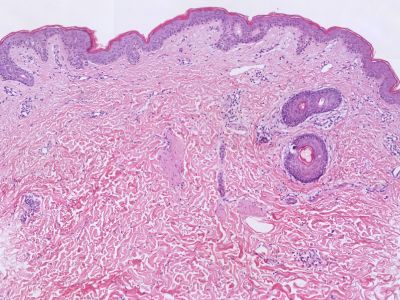 Histologie urticaria