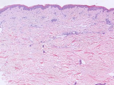 Histologie urticaria