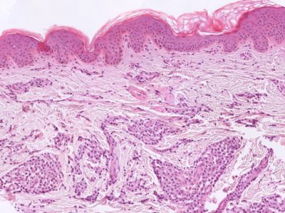 Histologie urticaria pigmentosa