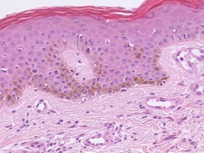 Histologie urticaria pigmentosa