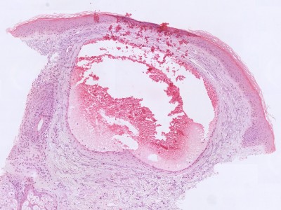 Histologie venous lake