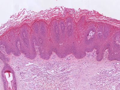 Histologie verruca plana