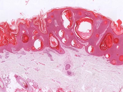 Histologie verruca seborroica