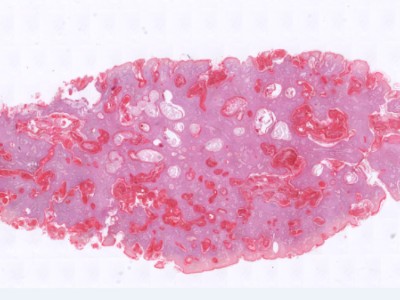 Histologie verruca seborroica