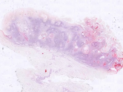 Histologie verruca seborroica