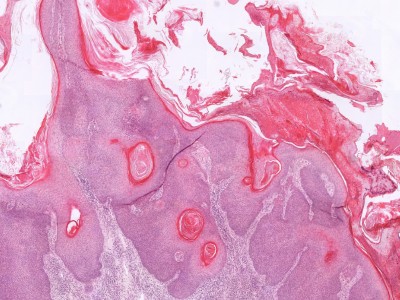 Histologie verruca seborroica