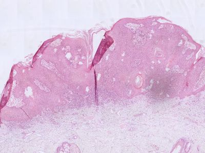 Histologie verruca seborroica