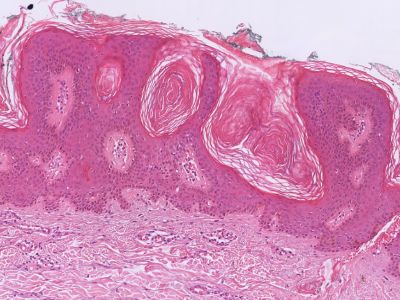 Histologie verruca seborroica