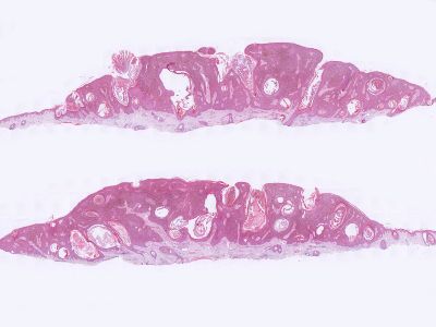 Histologie verruca seborroica