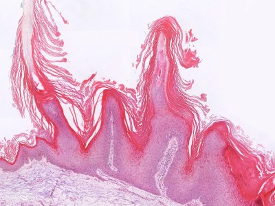 Histologie verruca vulgaris