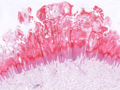 Histologie verruca vulgaris