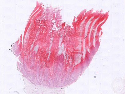 Histologie verruca vulgaris