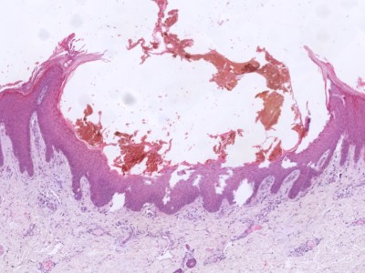 Histologie verruceus hemangioom