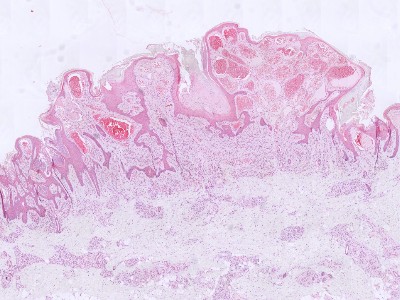 Histologie verruceus hemangioom