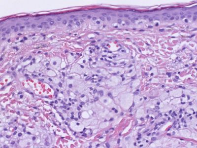 Histologie xanthelasma