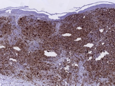 Histologie xanthogranuloom