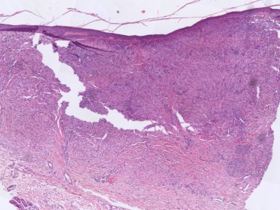 Histologie xanthogranuloom