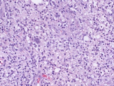 Histologie xanthogranuloom