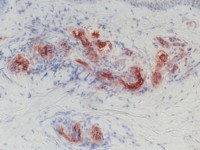 Leukocytoclastische vasculitis