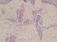 Leukocytoclastische vasculitis
