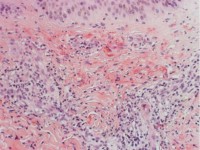 Leukocytoclastische vasculitis