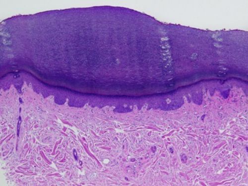 Compacte orthokeratose (voetzool)