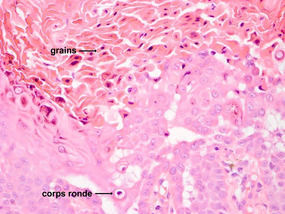Corps ronde en grains als kenmerk van dyskeratose 