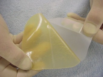 Duoderm Extra Thin hydrocolloid dressing