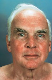 Efudix treatment Efudix