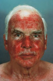 Efudix treatment Efudix