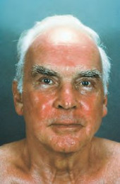 Efudix treatment Efudix